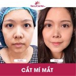 hinh-anh-sau-khi-cat-mi-mat-2.jpg